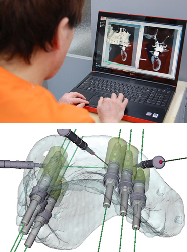 CT精密検査・コンピューター3Dシミュレーション