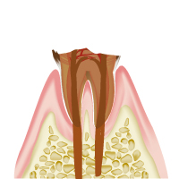 虫歯進行度C4
